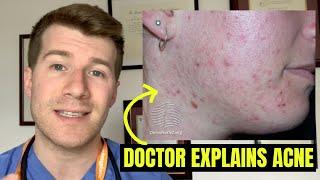 Doctor explains ACNE symptoms self-care treatment options and complications...