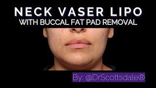 BUCCAL FAT PAD REMOVAL by @DrScottsdale