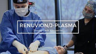 RenuvionJ-Plasma - Tummy Tuck Alternative?