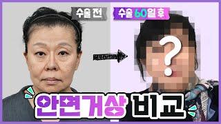 안면거상 주름 성형 60일 후 경과