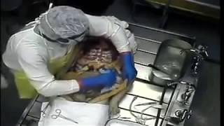 Full Body Medical Autopsy