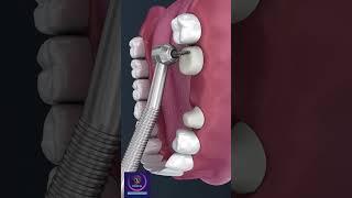 Tooth Supported Fixed Bridge of 3 Teeth #shorts