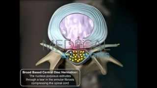 3D Medical Animation  Male Lumbar Central Herniation