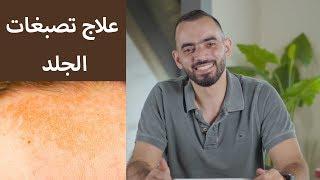 علاج تصبغات الجلد