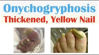 Onychogryphosis Thickened Yellow Nails  Causes Signs & Symptoms Diagnosis Treatment