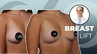 Breast Lift Recovery - What You Need to Know  Dr. David Stoker