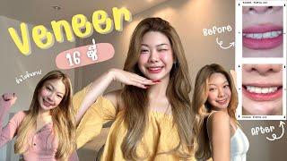 Veneer ทำวีเนียร์16ซี่ ทำไมถึงทำ? ดีไหม? ราคา?  bmalliya