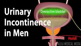 Urinary Incontinence in Men Animation