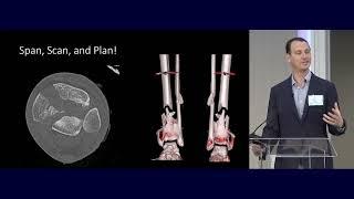 02  Pilon Fractures   David Shearer MD