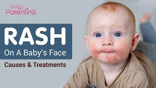 Rash On Babys Face -  Reasons and Remedies