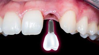 Cấy ghép implant cho răng cửa bị mất