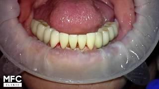 Виниры для зубов. Установка виниров на нижнюю челюсть. Dental veneers. 牙貼面。