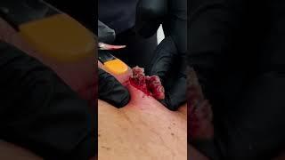 SATISFYING BACK CYST  PT 2