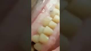 What does BRUXISM or Teeth Grinding sound like