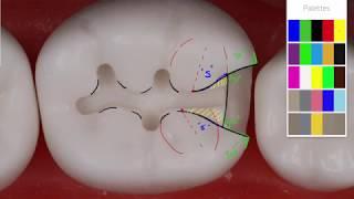 Class II Amalgam #19 MO Acadental  Amalgam Preparation Technique