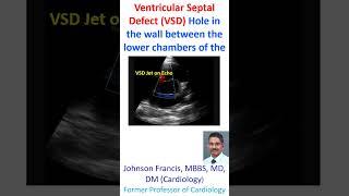 Ventricular Septal Defect VSD - hole in the wall between the lower chambers of the heart