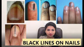 Black lines on nails- do you need to worry???  - MBBS MD MAMC SKIN- HINDI 2020