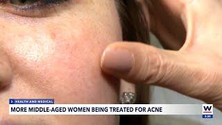 Women may never outgrow acne
