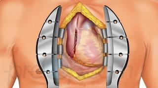 Coronary Artery Bypass Graft CABG  Off-Pump PreOp® Patient Education