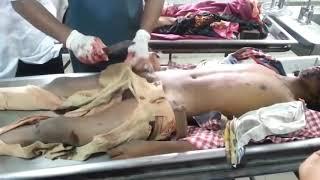 Postmortem videoDissection human body Alcohol patient