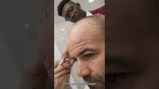 Hair transplant Reviews #shorts