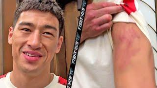 DMITRY BIVOL MORNING AFTER CANELO FIGHT SHOWS BRUISED ARM SAYS HE WANTS 168 UNDISPUTED TITLES