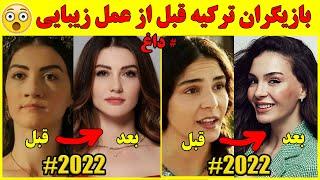 بازیگران ترکیه قبل و بعد از عمل زیبایی تا سال 2022  با سوژه های داغ