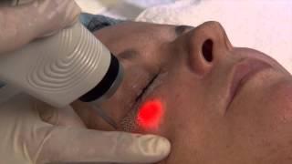 Ultapulse CO2 Laser Treatment Under the Eyes