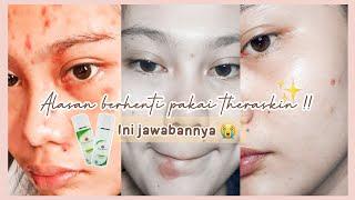 REVIEW THERASKIN ACNE SAMPE AKHIRNYA BERHENTI  part 2