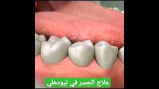 تركيب الأسنان و جسر الأسنان في الهند #اسنان #زراعة_الاسنان#الهند