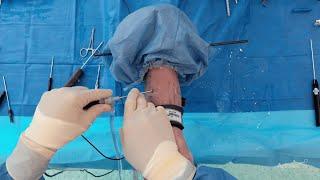 NanoNeedle Scope for Ankle Arthroscopy