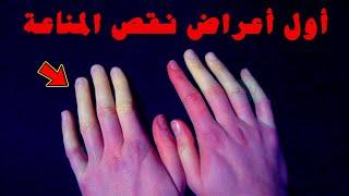 أول أعراض نقص المناعة  ما هي؟