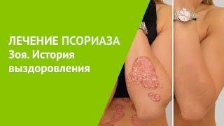 Лечение псориаза. Зоя история выздоровления.