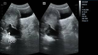 Pelvic Inflammatory Disease PID  Ultrasound