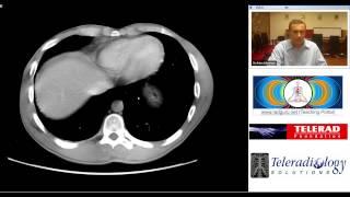 CT study of Perforated Duodenal Ulcer by Dr. Arjun Kalyanpur