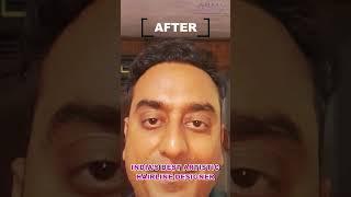 Incredible Hair Transplant Result delivered by Dr Arth Shah  Best Hair Restoration Results 2024