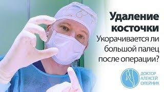 Удаление косточки на ноге укорачивается ли большой палец после операции?  Доктор Алексей Олейник