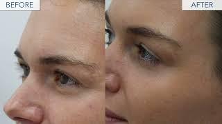 BOTOX Before and After 30s anti-wrinkle treatment London UK