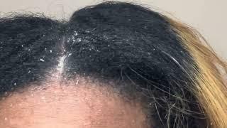 Stubborn Flakes Dandruff Scratching Psoriasis Stuck to Scalp *60 Second Clip*