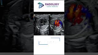 Transposition of the Great Arteries TGA #Dr.Swapna