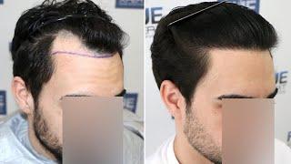 FUE Hair Transplant 1531 Grafts NW III A By Dr Juan Couto - FUEXPERT CLINIC Madrid Spain