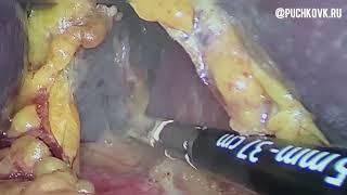 Лапароскопическая спленэктомия с аутотрансплантацией селезеночной ткани в большой сальник