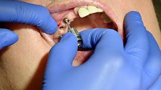 How we do it 5 crowns for only 3 implants