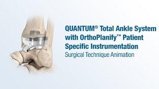 QUANTUM® Total Ankle System with OrthoPlanify™ Patient Specific Information - CONMED Animation