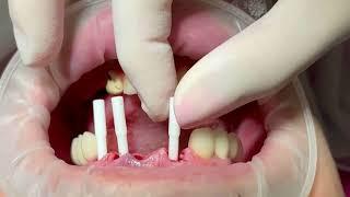 Guided Immediate Implant Placement in the Anterior Zone with MIS Prosthetic Guide