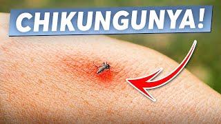 चिकनगुनिया से होने वाले जोड़ों के दर्द मे आराम के लिये ये करे Cure Joint Pain due to Chikungunya