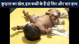 कुदरत का खेल इस बच्ची के हैं दो सिर और चार हाथ  News18 Hindi