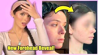 Facial Feminization Surgery REVEAL & Procedures Explained Transgender Transition Update