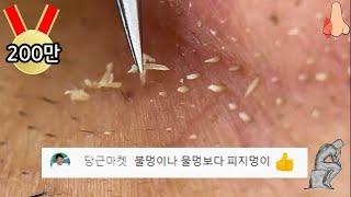 tweezer 피지제거 멍 때리고 보게 되는 피지제거 영상 피지멍