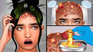 ASMR Head Acne Removal and Pimples Popping  Itchy Scalp Treatment ASMR